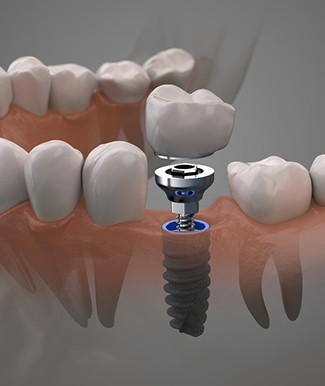 Diagram of dental implants in Ocala