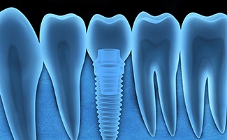 Diagram of an integrated dental implant in Ocala
