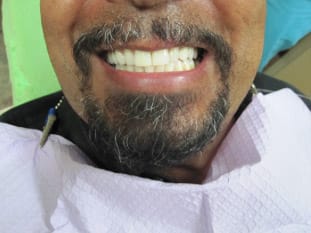 After dental bridges