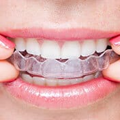 Invisalign aligner in Ocala