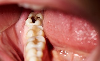 Closeup of a dental cavity