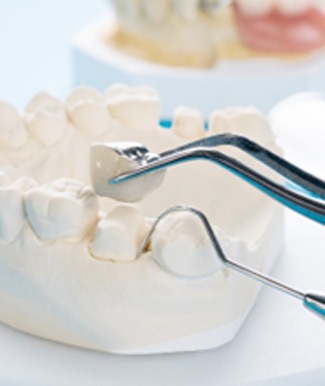 Model of dental implants in Ocala in model jaw
