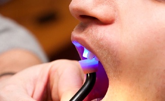 dentist shining curing light on patient’s tooth