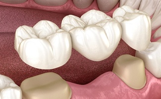 Digital diagram of a dental bridge in Ocala