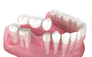 Digital diagram of a traditional dental bridge in Ocala