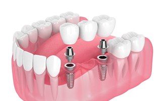 Digital diagram of an implant bridge in Ocala