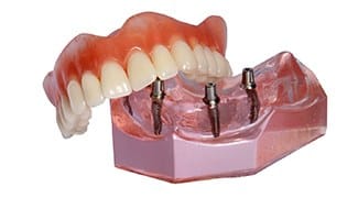 Model of an implant-retained denture.