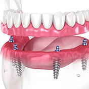 a digital illustration of all-on-4 dentures in Ocala