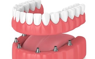 Dentures about to be placed on six dental implants