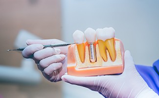 dentist explaining the cost of dental implants in Ocala