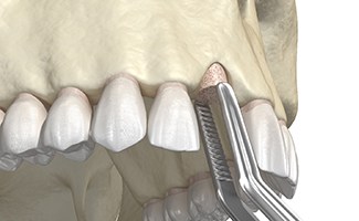 diagram of a bone graft or preliminary treatment