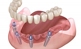 specific parts of the dental implants in Ocala