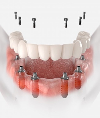 a 3 D illustration of dental implants and a denture