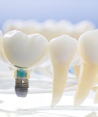 Model of dental implants in Ocala in model jaw