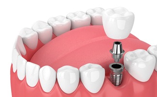 3D illustration of a single dental implant for bottom arch of smile