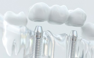 Model of an implant-supported dental bridge