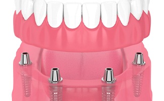 3D illustration of an implant denture