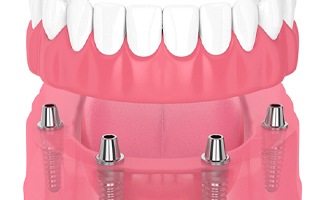 3D illustration of an implant denture