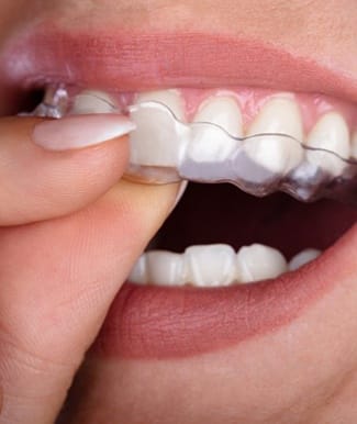 close-up of a person putting an Invisalign tray in their mouth 