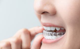 Patient placing clear aligner on bottom teeth