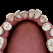 Crooked teeth, a factor that affects the cost of Invisalign