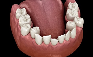 Illustration of crowded teeth