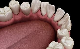 Illustration of gapped teeth