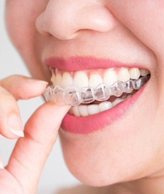 Closeup of woman placing clear aligner on top teeth