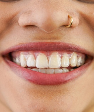 Closeup of woman with clear aligners smiling