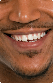 Man smiling with chipped tooth