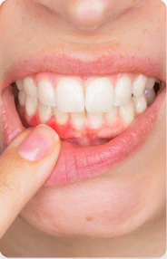 A person pointing to bleeding gums