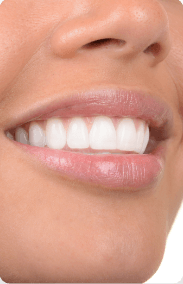 A smile with dental crowns