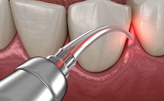 Gum disease laser treatment in Ocala