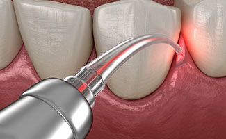 Gum disease laser treatment in Ocala