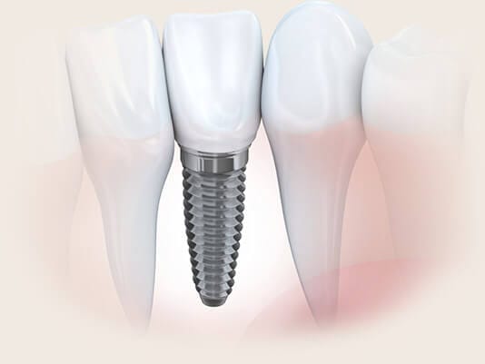 implant between teeth