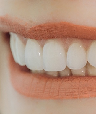 Woman smiling with veneers in Ocala