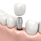 computer illustrated implant