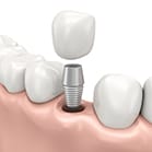 computer illustrated implant