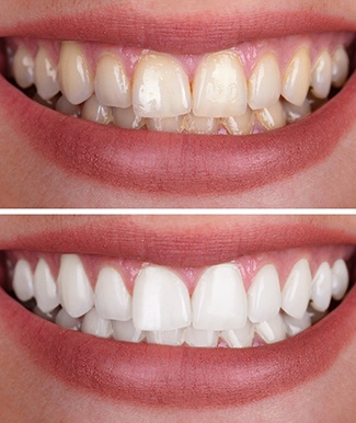 Closeup of patient's smile before and after teeth whitening