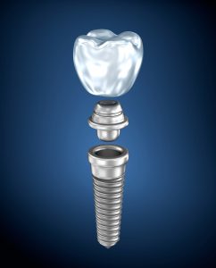 earn how to properly care for dental implants in Ocala FL.