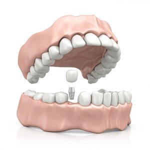 Your dentist for dental implants in Ocala, FL.