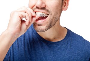 How do I clean my Invisalign in Ocala, FL?