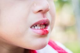 Child with a bleeding lip