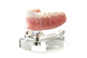 Implant-supported denture