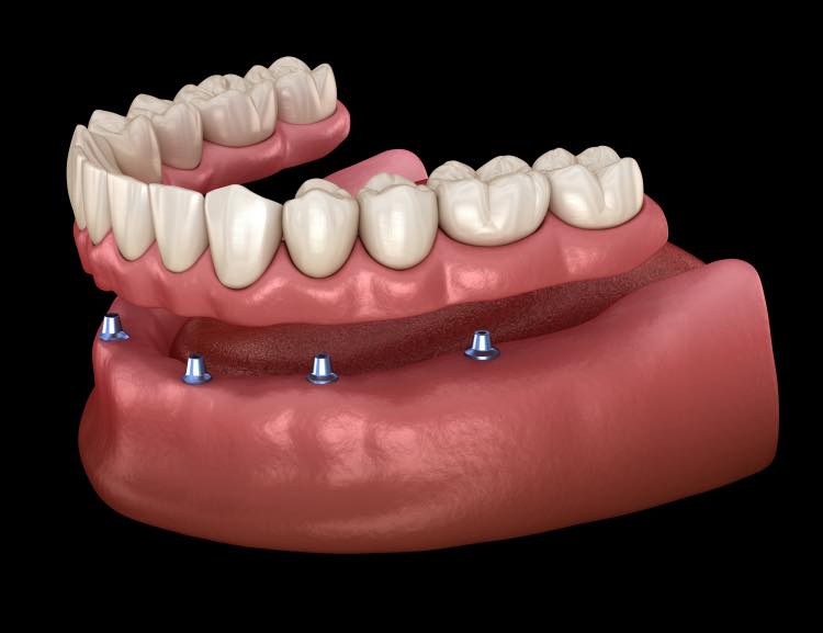 Digital image of a lower implant denture 