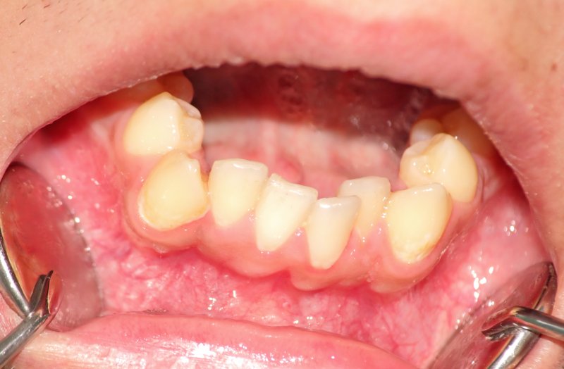 overcrowded teeth