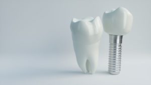 dental implant in Ocala next to natural tooth 