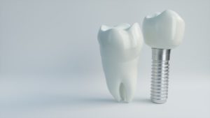 dental implant in Ocala next to natural tooth