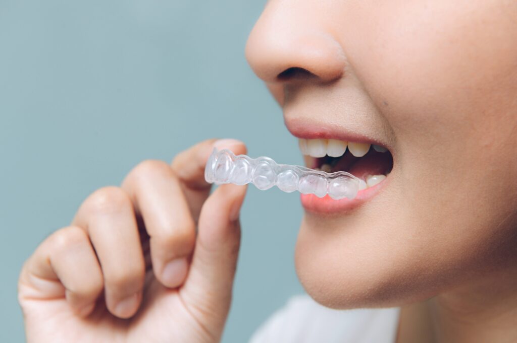 Closeup of patient putting on clear aligner