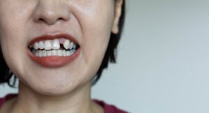 Woman smiling with missing front tooth.